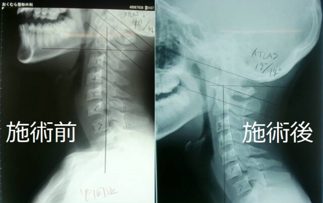 頚椎ヘルニア・頚椎分離症の施術前と施術後の違い